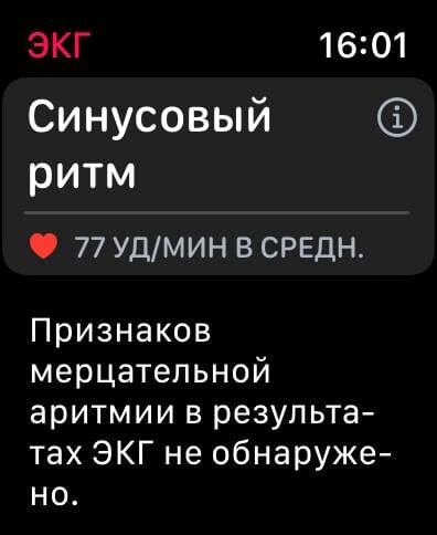 Синусовый ритм в норме. Но если есть подозрения, нужно обратиться к врачу. Apple Watch — это не медицинский прибор. 